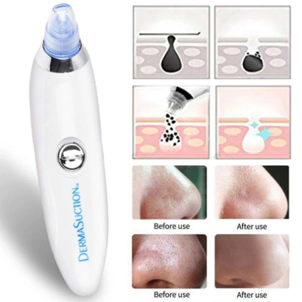 Vacuum Blackhead Remover Face Black Spots Cleaner White Dot Pimple Removal